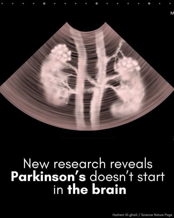 Echographie de reins. La maladie de Parkinson commencerait-elle dans les reins ?